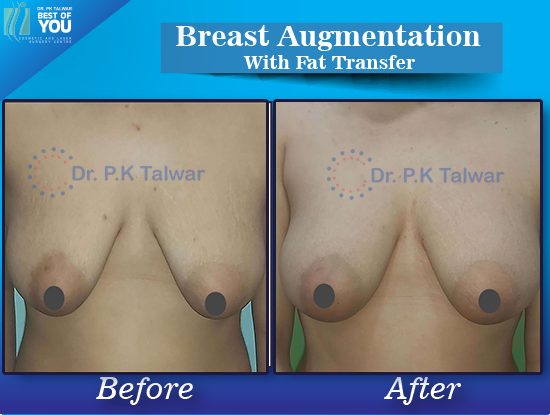 Breast Augmentation with fat injection result